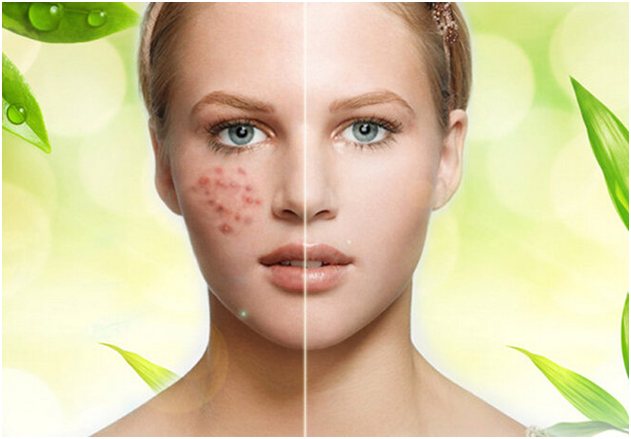 祛痘护理
